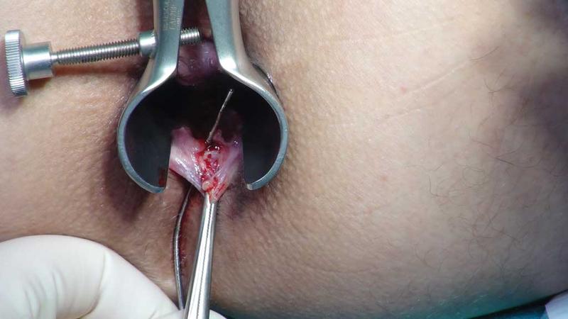 Leczenie szczeliny odbytu