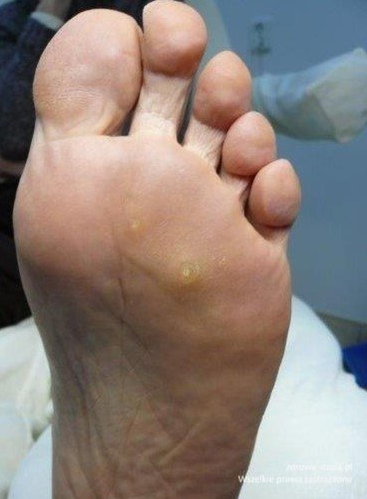 Domowe metody na odciski