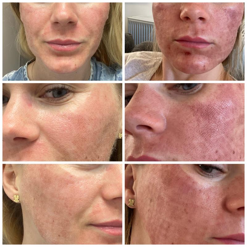 Laser frakcyjny medycyna estetyczna