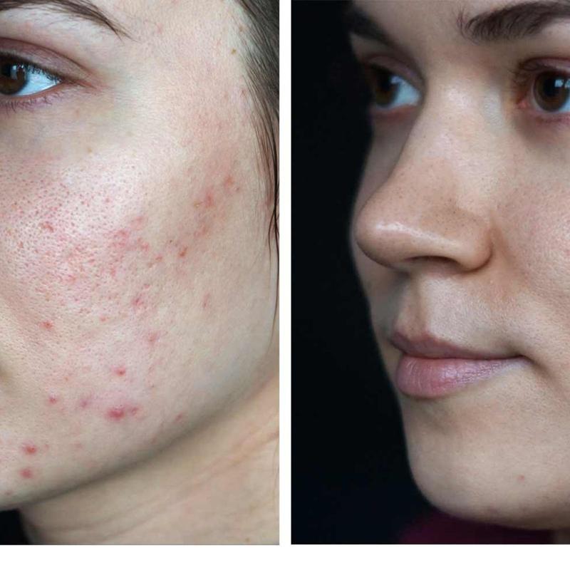 Pielęgnacja blizn po oparzeniach