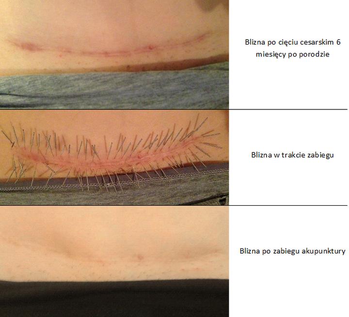 Regeneracja skóry po oparzeniach