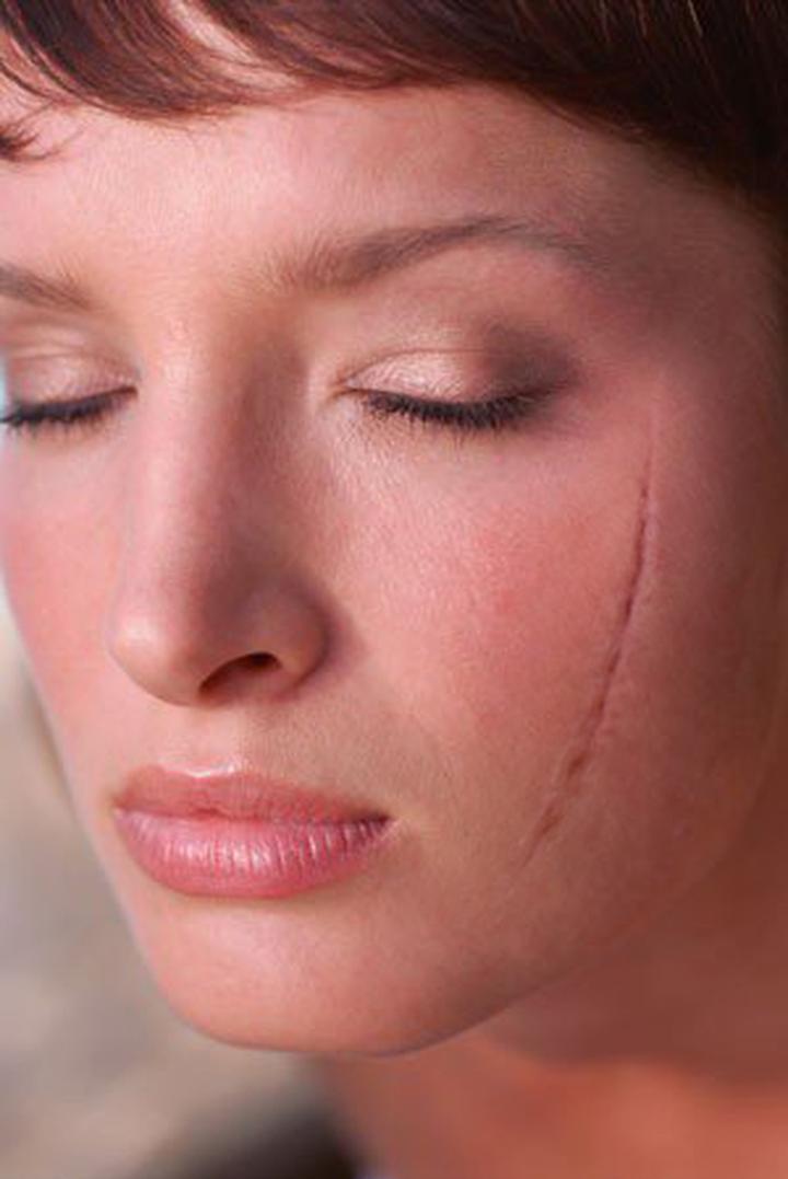 Naturalne metody na blizny