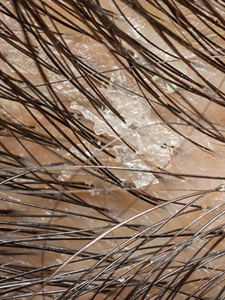 Naturalne metody na łupież