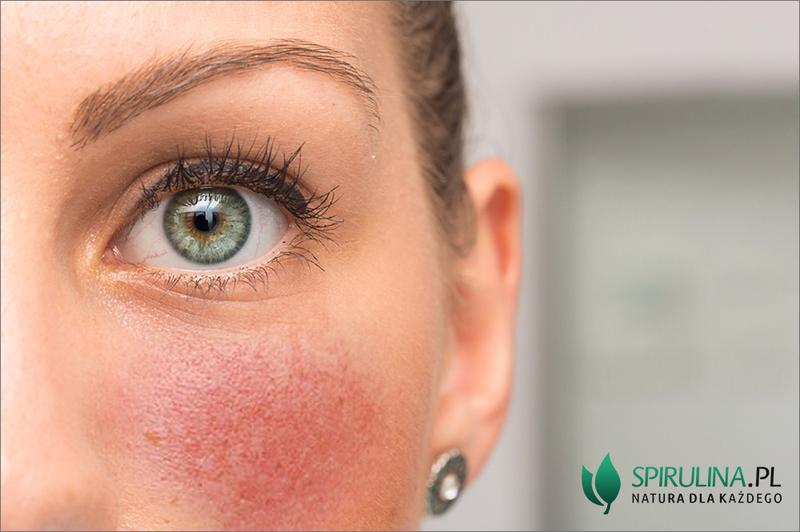 Naturalne metody na rumień