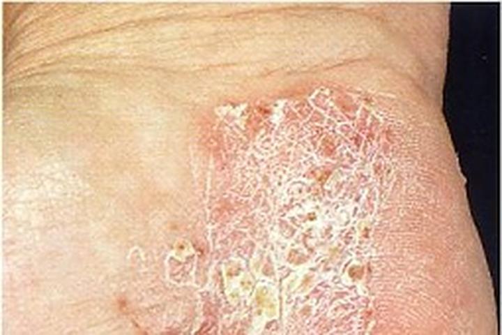 Alternatywne terapie łuszczyca