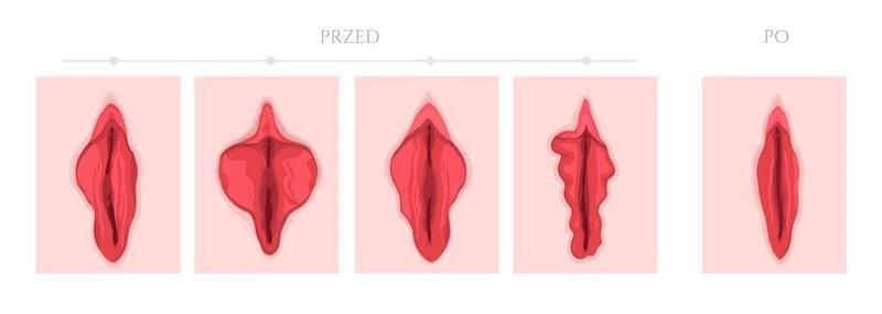 Aspekty psychologiczne przerostu