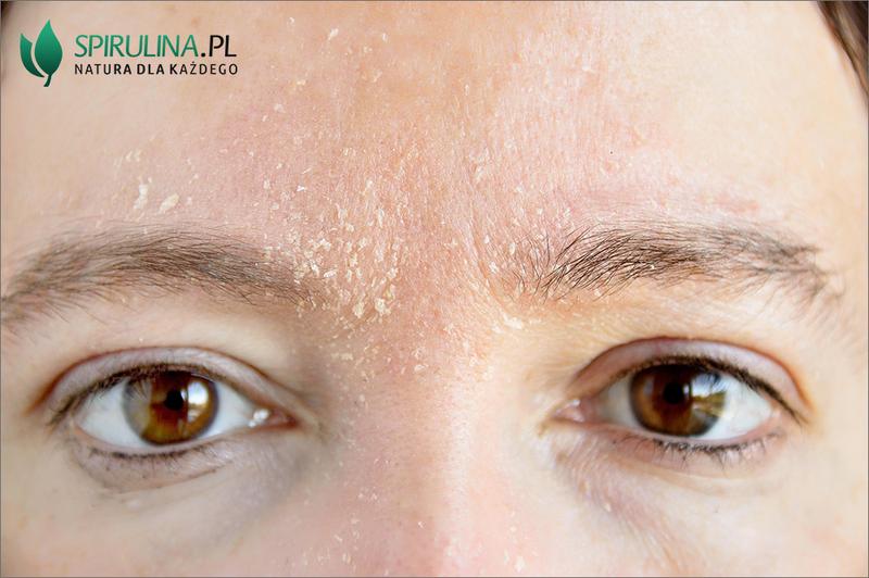 Dieta a zapalenie skóry