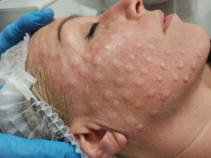 Efekty mezoterapii igłowej