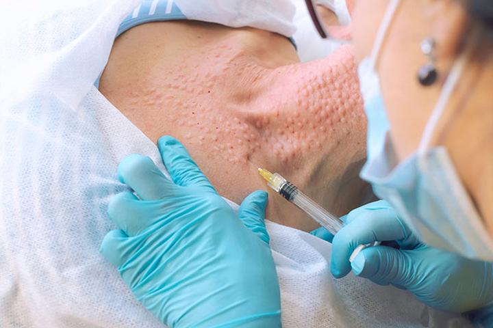 Korzyści mezoterapii igłowej