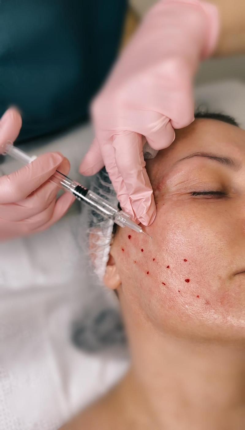 Mezoterapia igłowa działanie