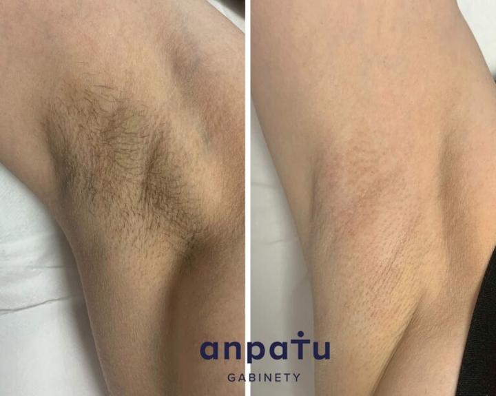 Przygotowanie skóry depilacja