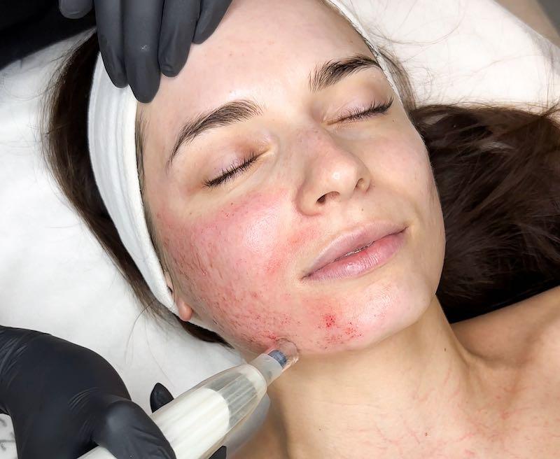 Substancje w mezoterapii