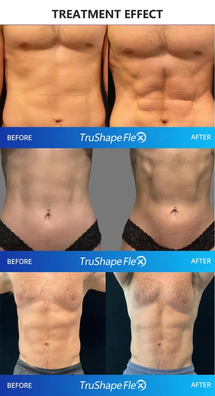 Trusculpt Flex