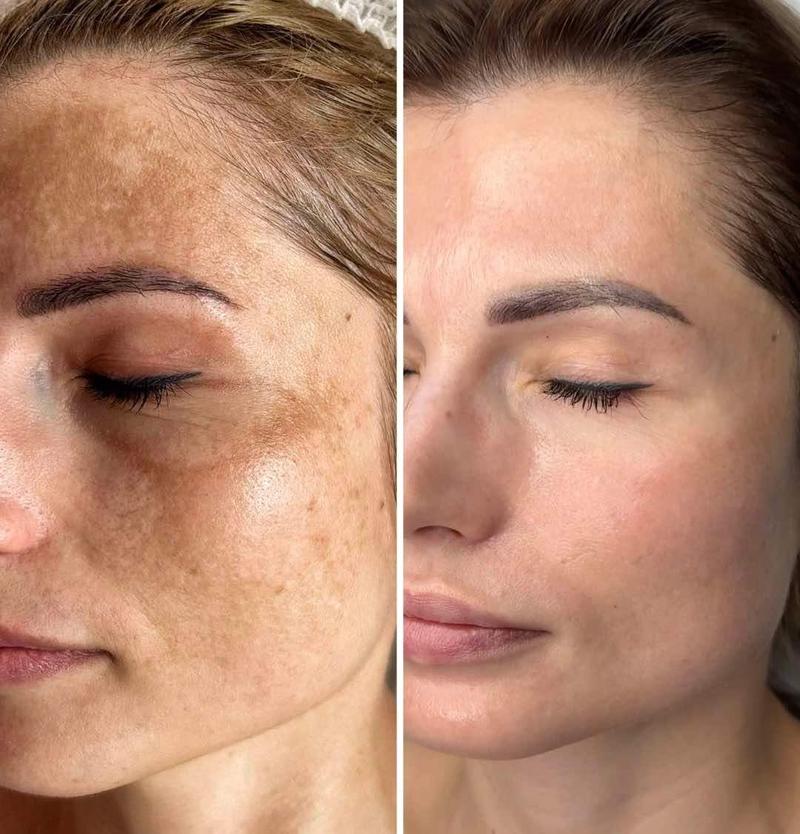 Bezpieczeństwo laserów w estetyce