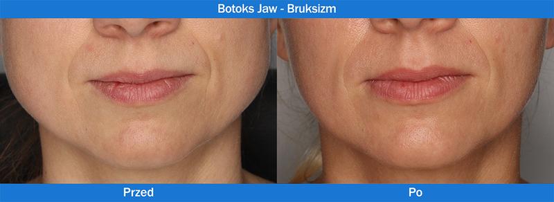 Botoks w terapii