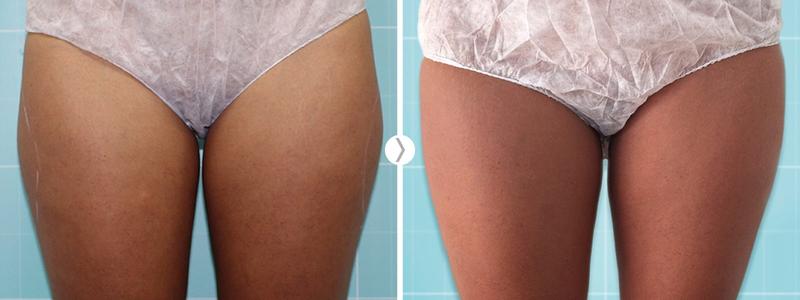 Kriolipoliza modelowanie sylwetki