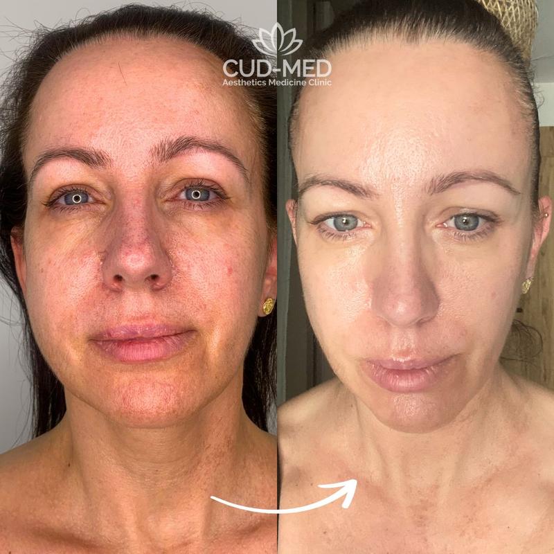 Laser tulowy w medycynie estetycznej