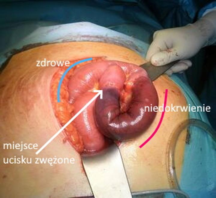Leczenie przepukliny okołopępkowej