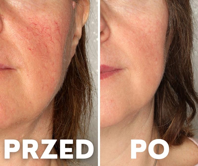 Naturalne sposoby na naczynka