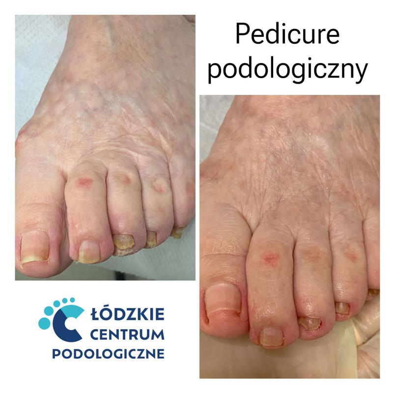 Pedicure podologiczny