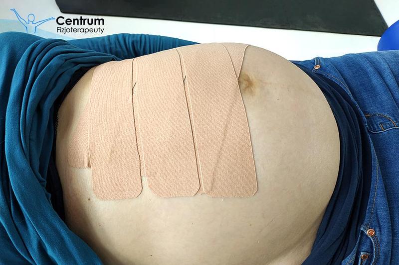 Przepuklina okołopępkowa objawy