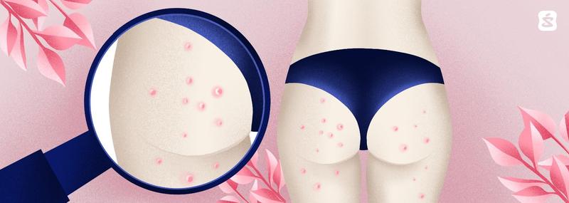 Trądzik na pośladkach