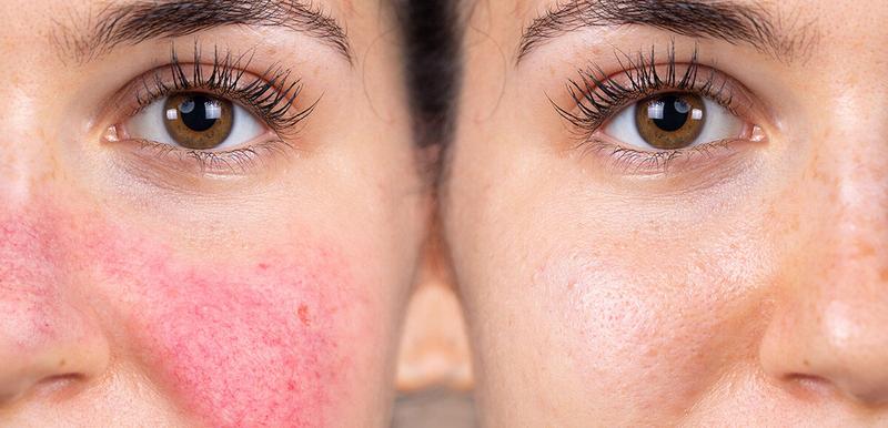 Zabiegi medycyny estetycznej