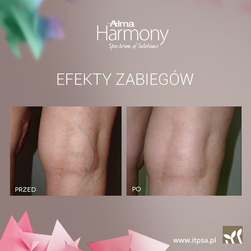 Zamknięcie naczynek