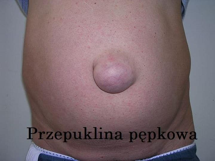 Zapobieganie przepuklinie okołopępkowej