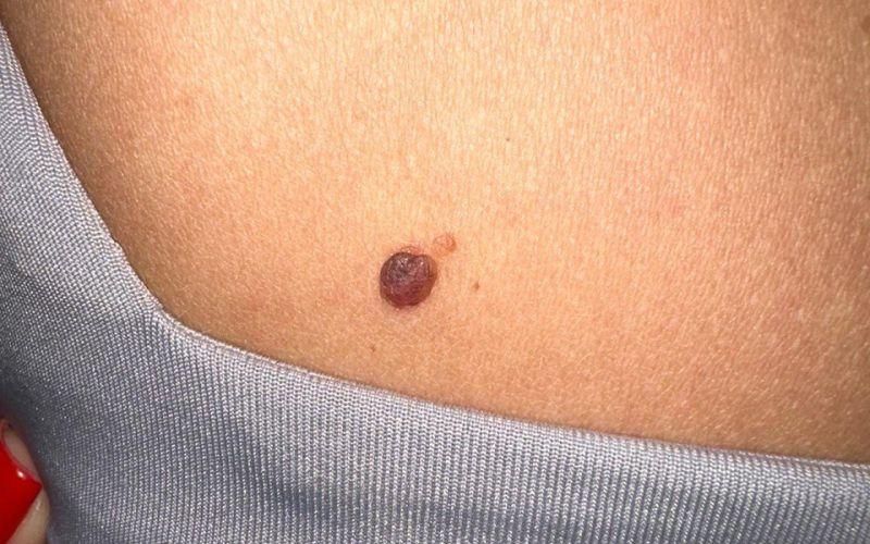 Zdrowotne właściwości pieprzyków