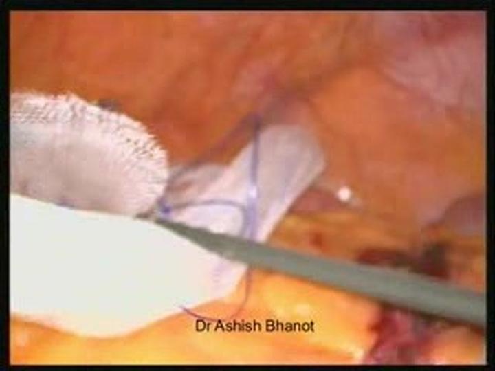 Jak rozpoznać i skutecznie leczyć przepuklinę okołopępkową?