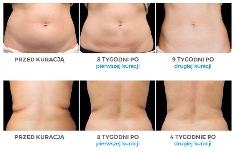 Kriolipoliza – rewolucyjna metoda modelowania sylwetki bez skalpela