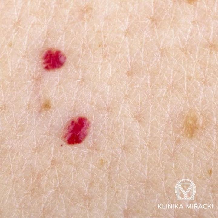 Odkryj fascynujący świat pieprzyków: wszystko, co musisz wiedzieć