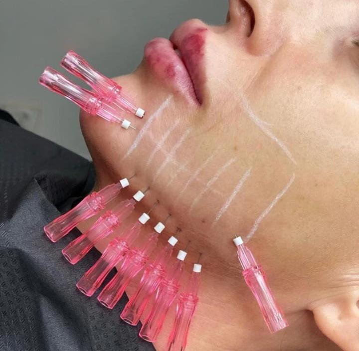 Odmładzanie skóry z użyciem nici rewitalizujących PDO – sekrety skutecznej metody piękna