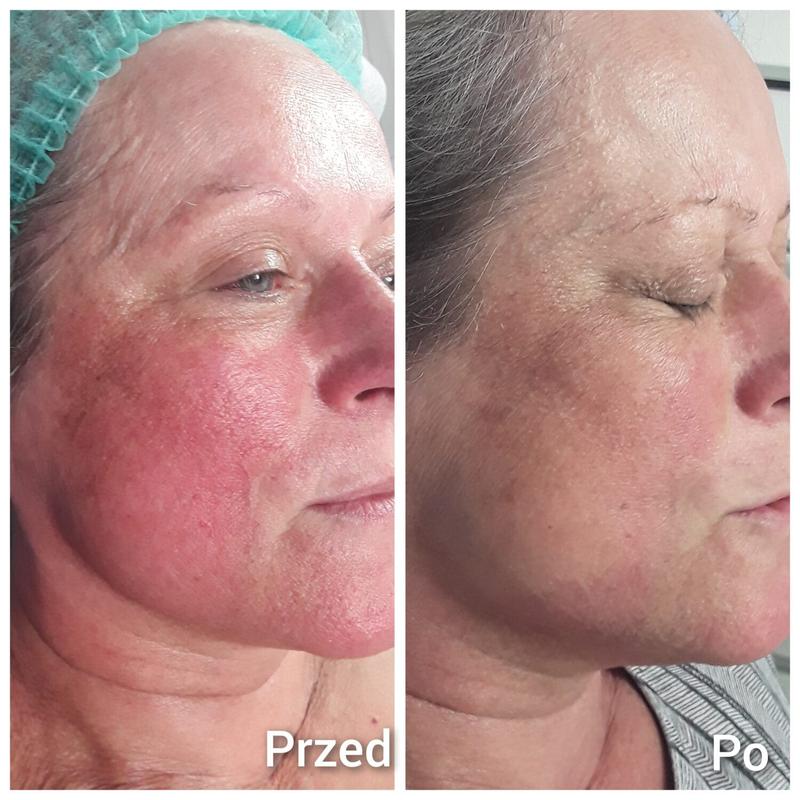 Skuteczne metody na zamykanie naczynek – zadbaj o zdrową skórę