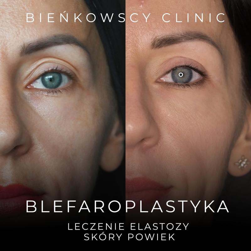 Ćwiczenia na zdrowe i jędrne powieki