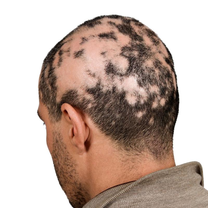 Łysienie plackowate porady i leczenie