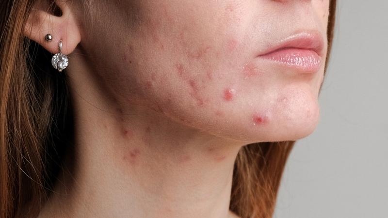 Naturalne metody trądziku