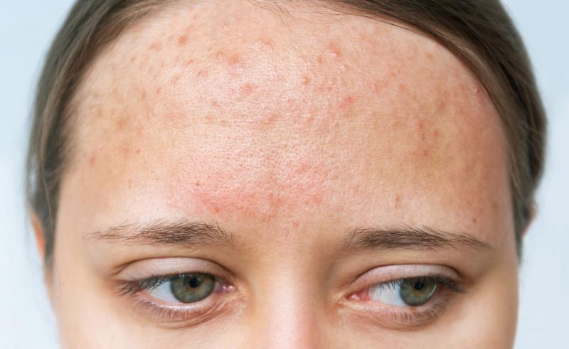 Jak skutecznie radzić sobie z trądzikiem hormonalnym? Poradnik dla zmagających się z problemem