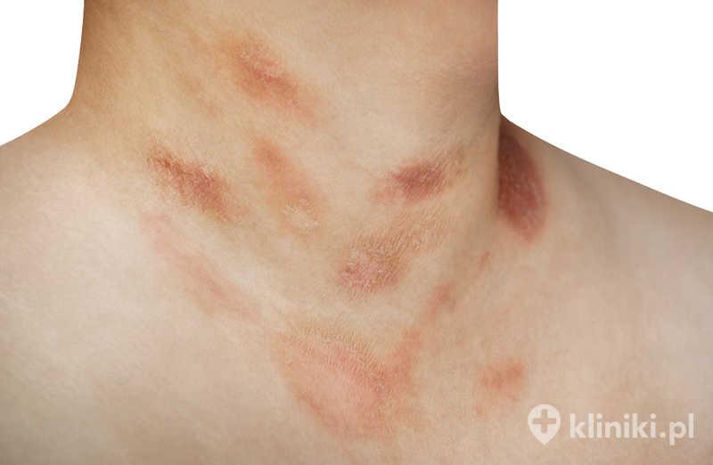 Skuteczne sposoby na walkę z łupieżem Giberta – co warto wiedzieć?