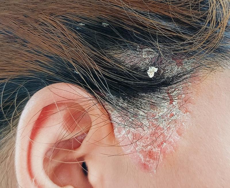 Naturalne sposoby na atopowe zapalenie skóry