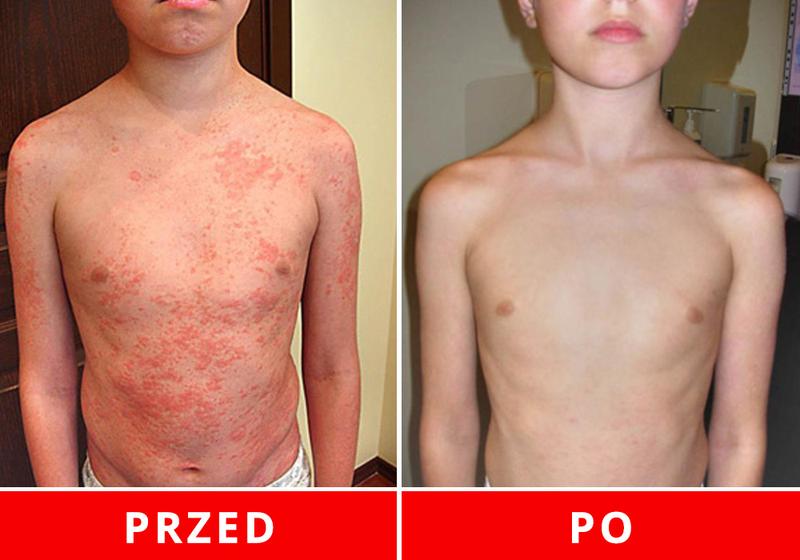 Pielęgnacja skóry atopowej i kosmetyki