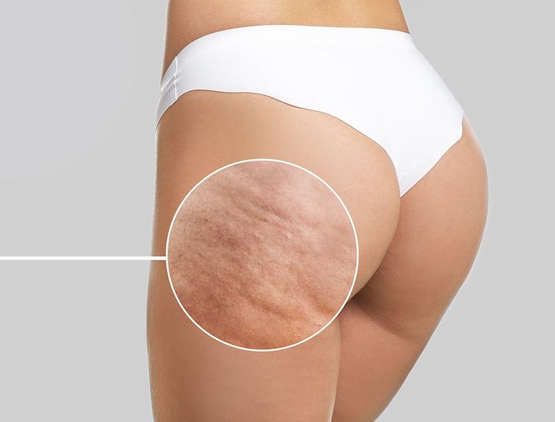 Skuteczne metody walki z cellulitem: Jakie zabiegi warto wypróbować?