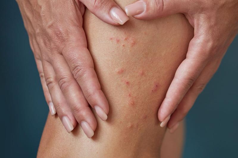 Schorzenia powodujące krosty