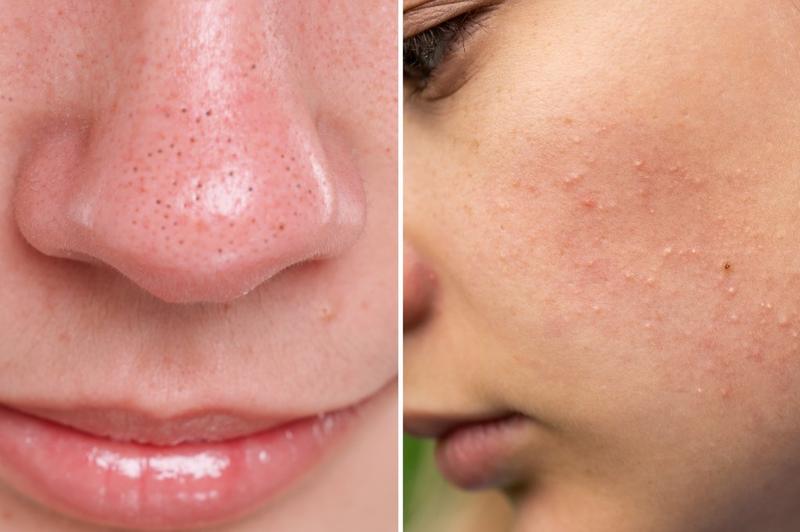 Jak skutecznie pozbyć się zaskórników zamkniętych i przywrócić skórze blask?