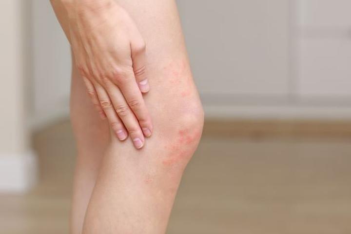 Naczyniak płaski: Co warto wiedzieć o tym powszechnym schorzeniu?