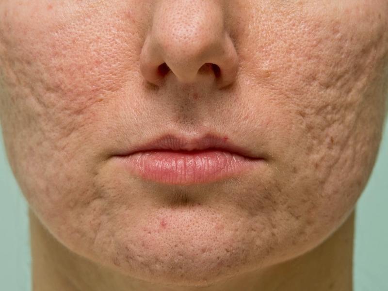 Rewolucyjna technologia: jak laser CO2 zmienia oblicze medycyny estetycznej