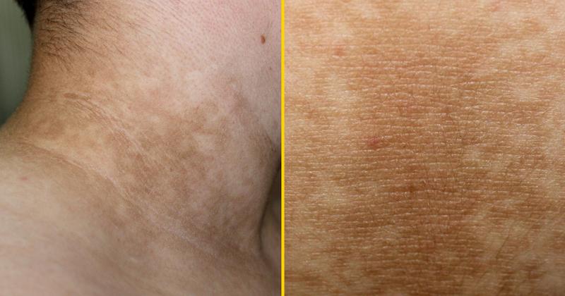 Leczenie rogowacenia ciemnego