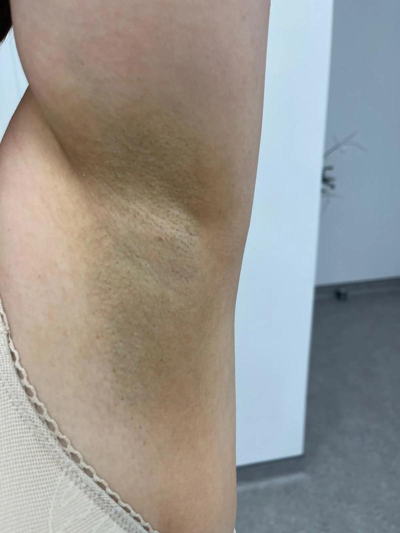 Objawy i diagnoza rogowacenia ciemnego