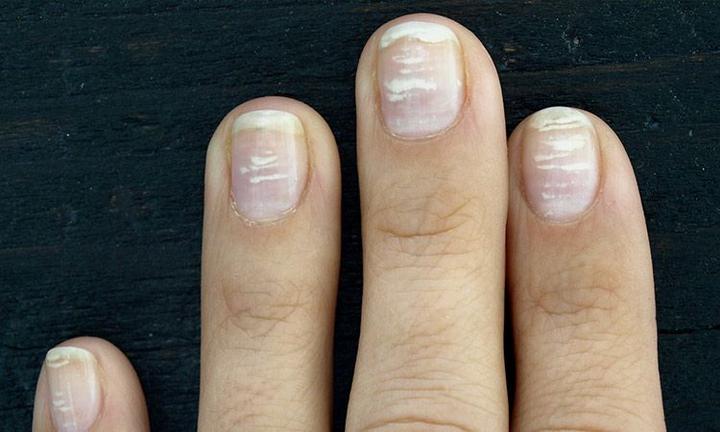 Białe plamki na paznokciach – co mogą oznaczać dla twojego zdrowia?